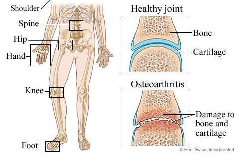 How osteoarthritis can damage joints