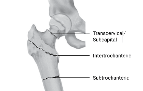 hip-fracture-types.png