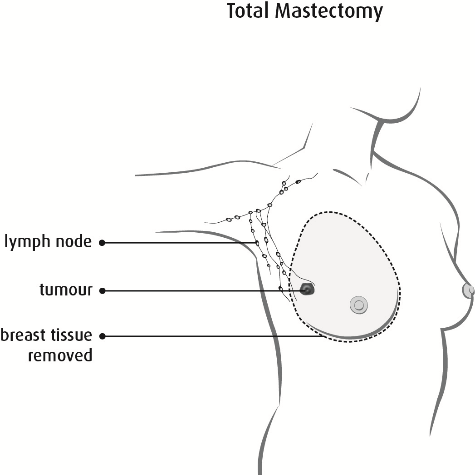 total-mastectomy