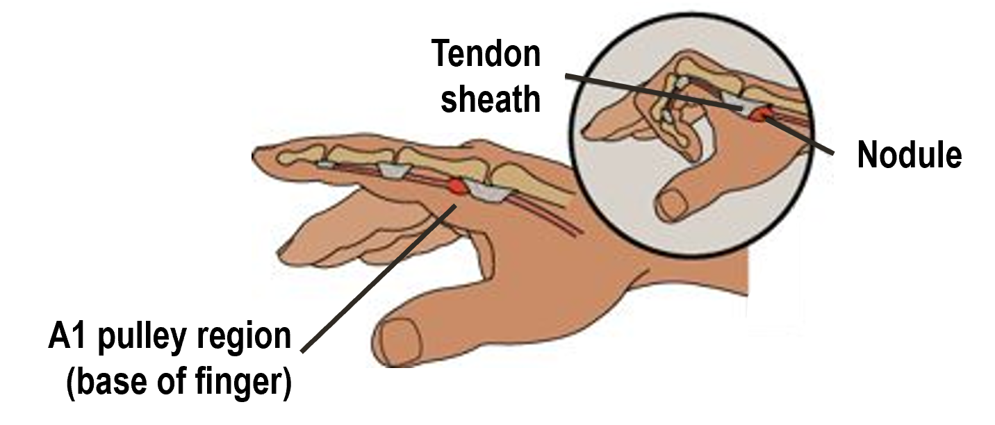 Inside view of the index finger, showing the tendon sheath, A1 pulley region, and nodule.
