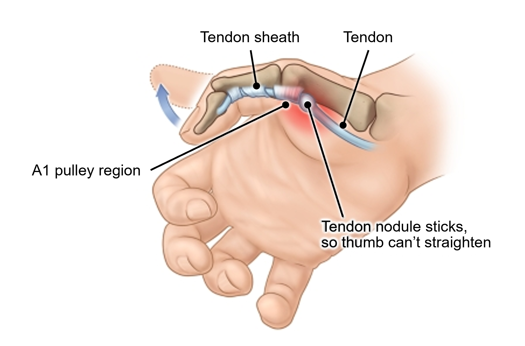 Inside view of the thumb, showing the tendon, tendon sheath, A1 pulley region, and tendon nodule. Tendon nodule sticks so the thumb can't straighten.