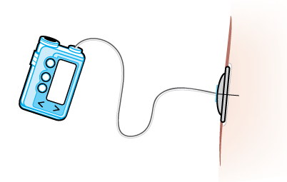 A 90-degree, or straight, cannula under the skin.