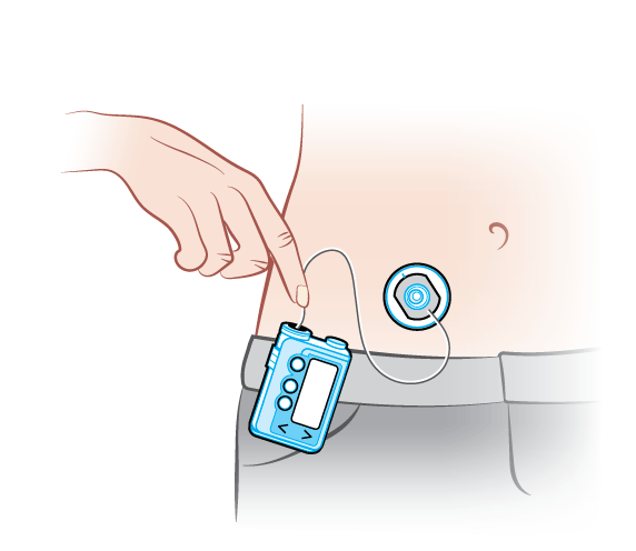 Insulin pump with tubing inserted in the belly.