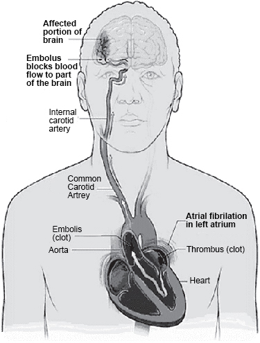 Blood Clot in the brain 